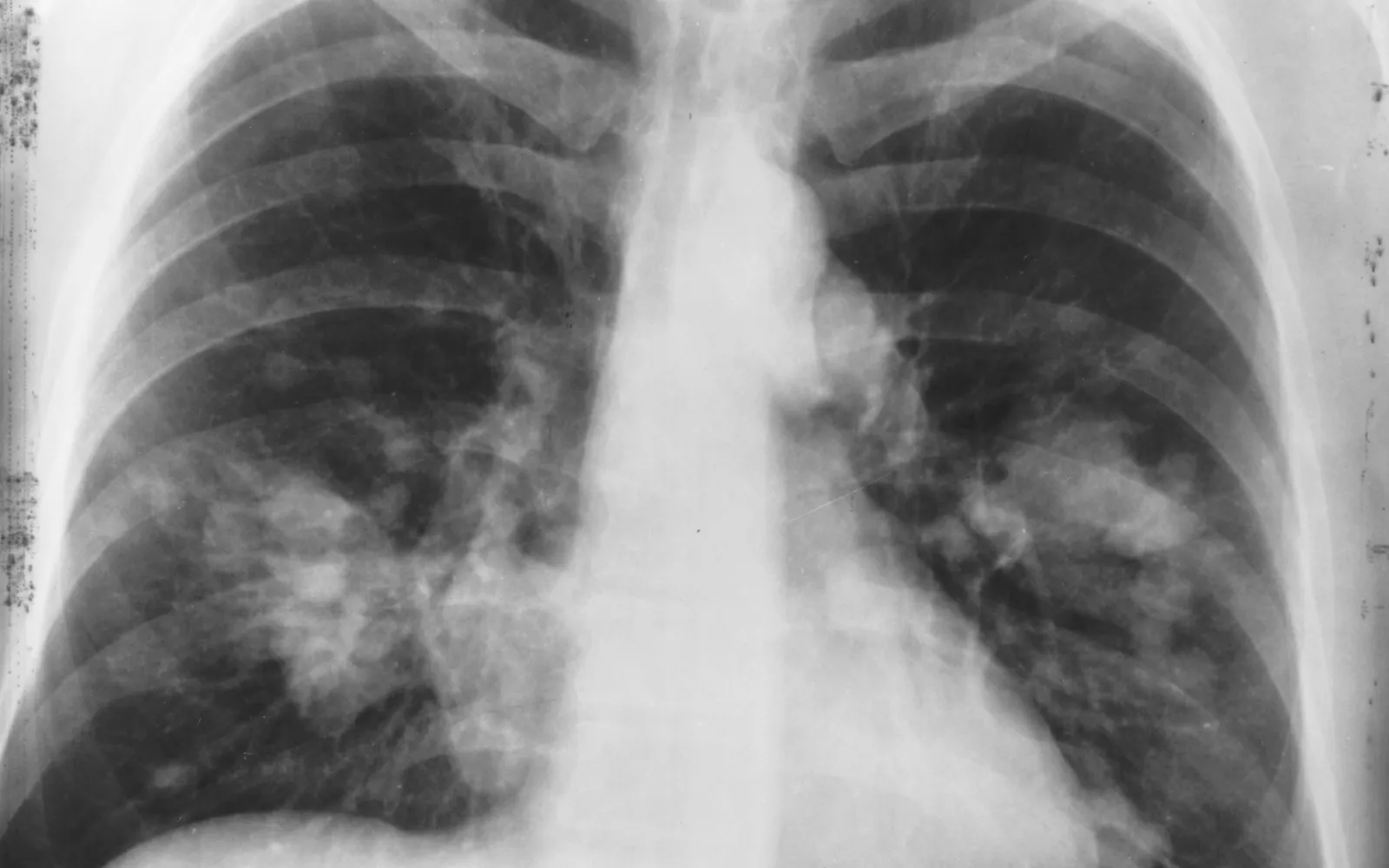 A black and white chest X-ray showing both lungs, with a growth on one side