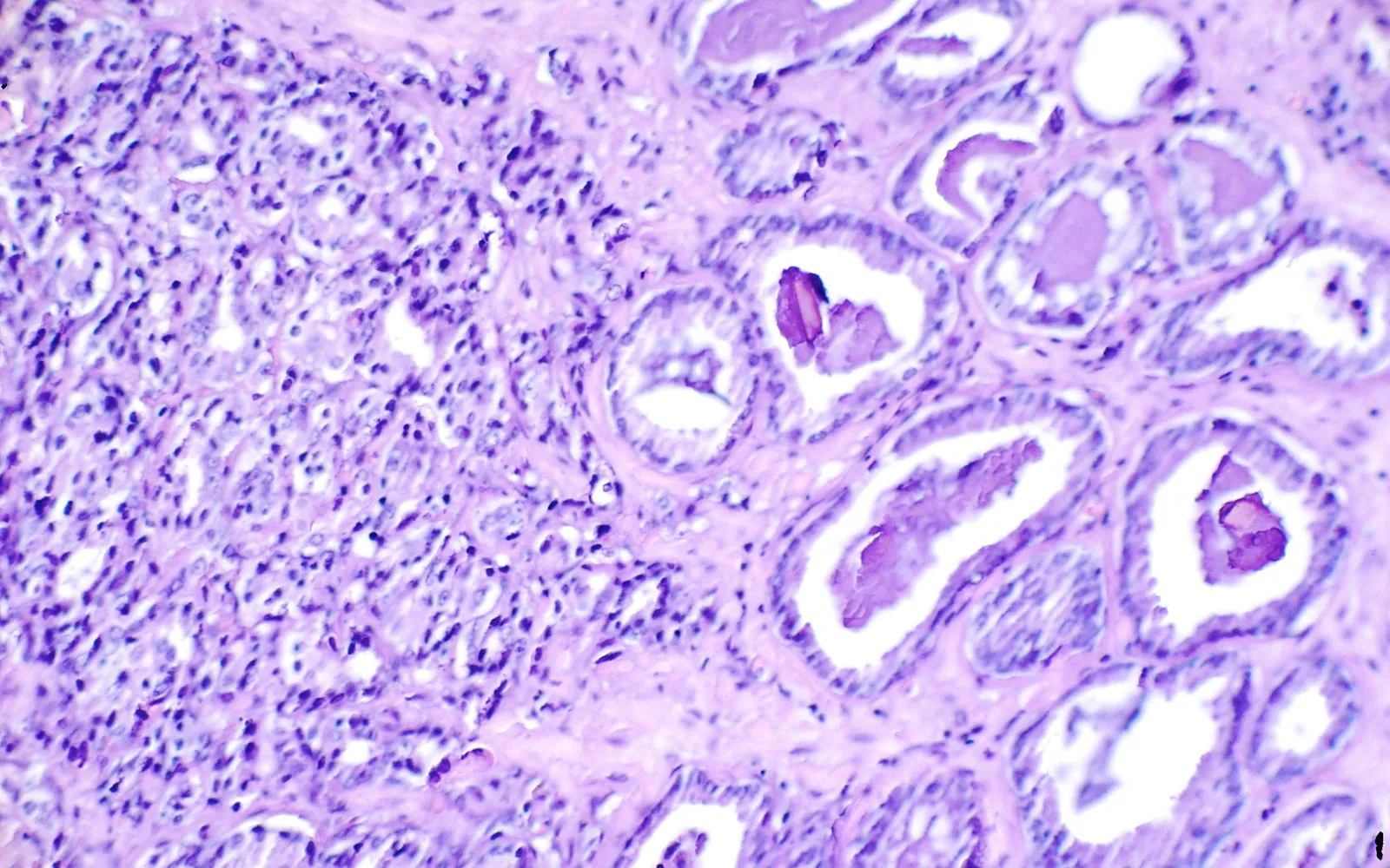 A microscope slide of prostate cancer tissue stained purple and pink