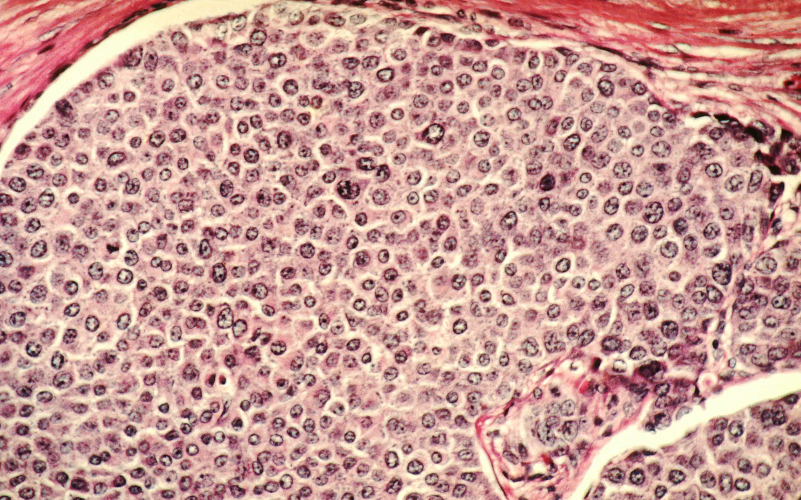 A pink and purple stained microscope slide shows a breast duct packed with tumor cells