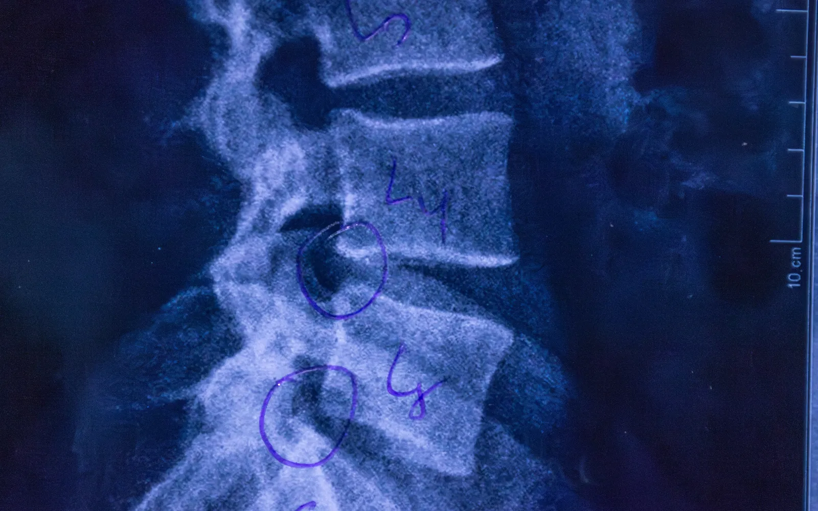 Side view X-ray of a lower spine with the L4 and L5 vertebrae labeled and two disc levels circled in pen