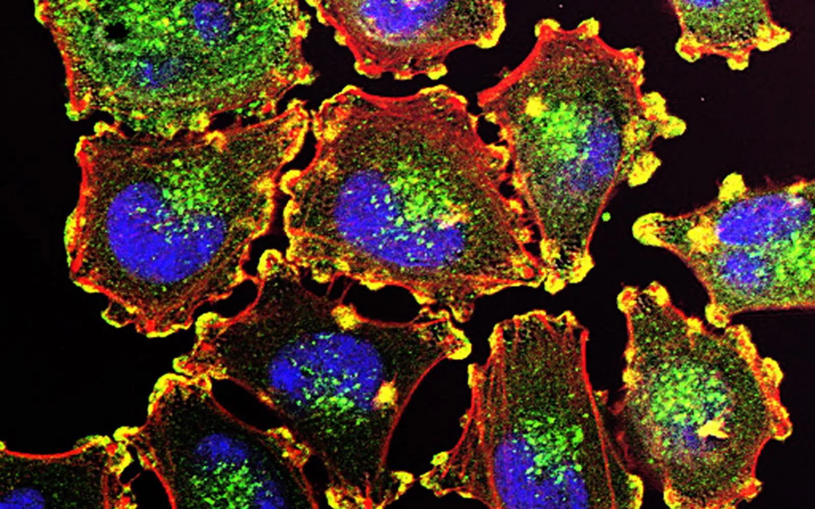 Fluorescent microscope image of melanoma cells on a black background, with blue nuclei, red and green cell structures and yellow podosomes