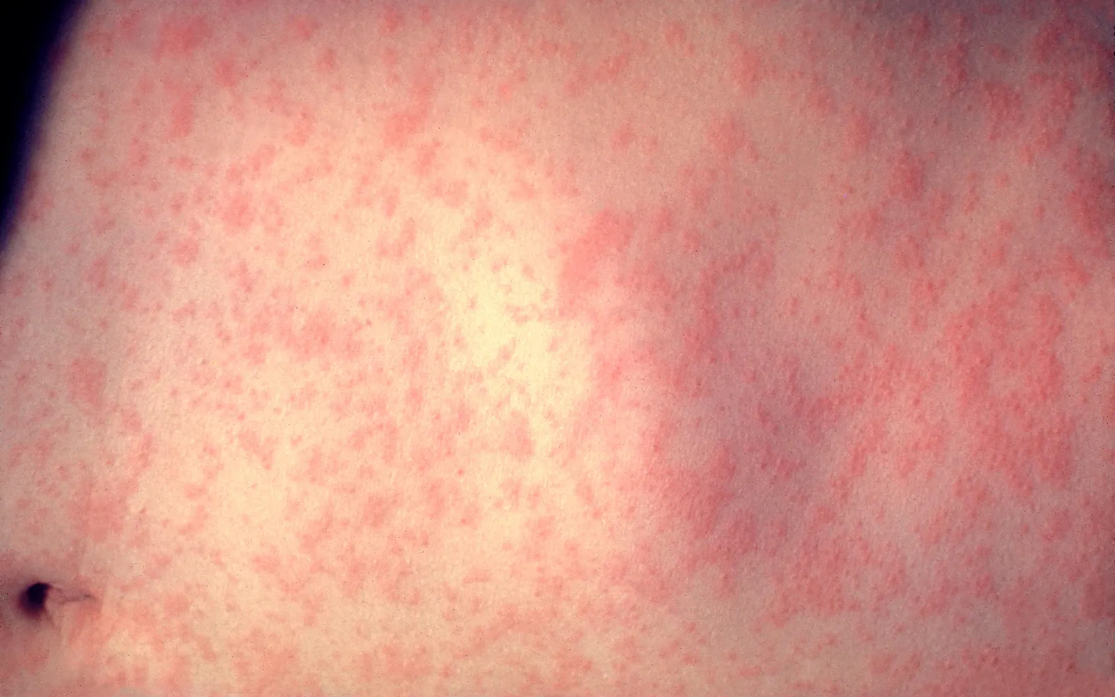 Close view of the red, blotchy measles rash spread across a patient's abdomen on the third day of infection